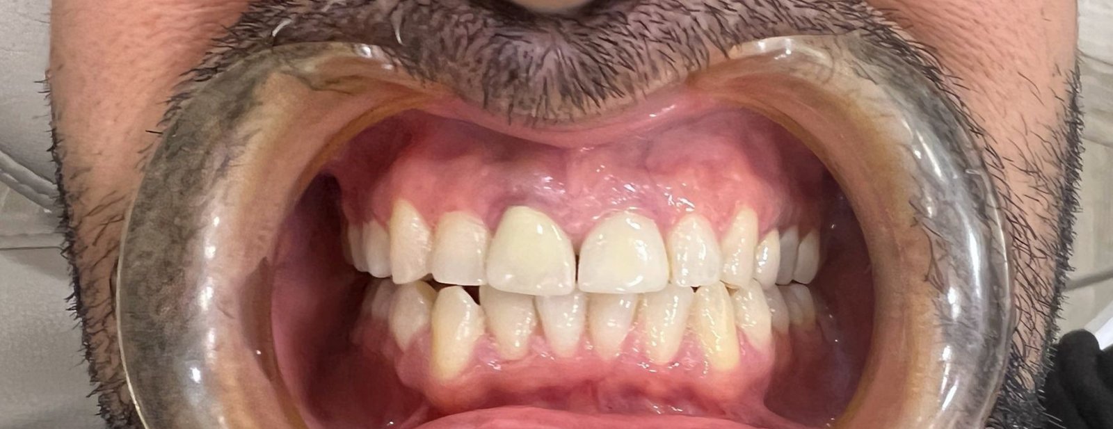 הלבנת שיניים