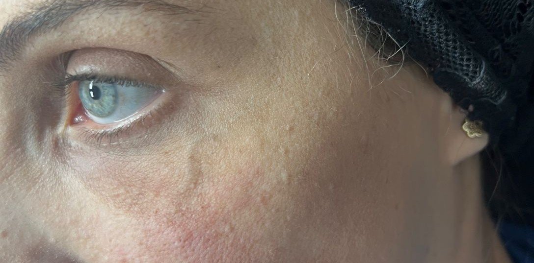 שקעי-עיניים