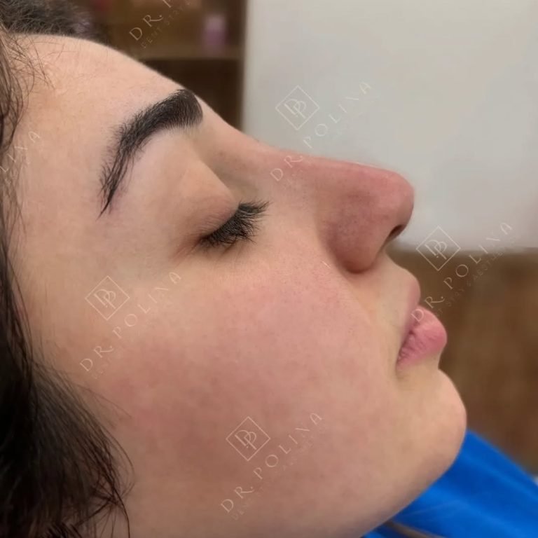 זה מה שנקרא אף מושלם וטבעי 🙌#nosejob #filler #פיסולאףללאניתוח #perfectnose